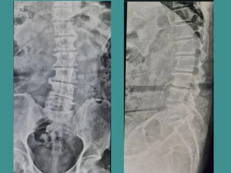 intervertebral-disc-problems-cover