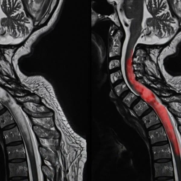 spinal tumor