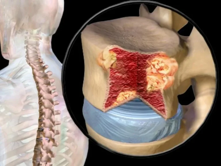 spine-tumors-cover