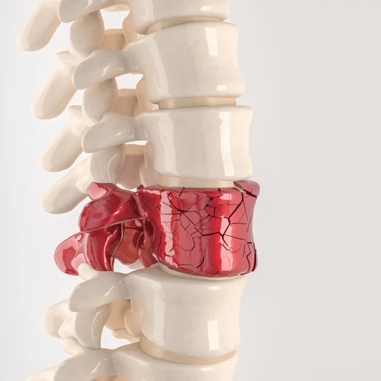 vertebral fracture